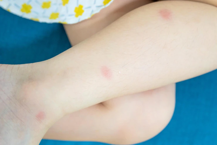 get rid of mosquito bite scars.