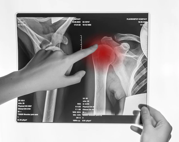 how to fix a dislocated shoulder.