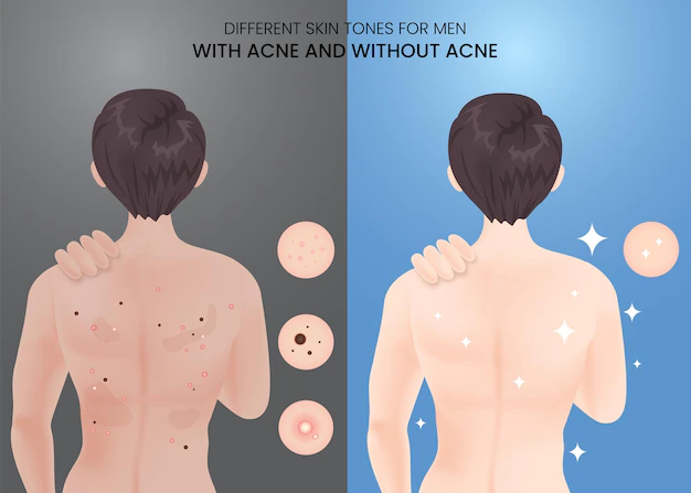 how to get rid of back acne scars
